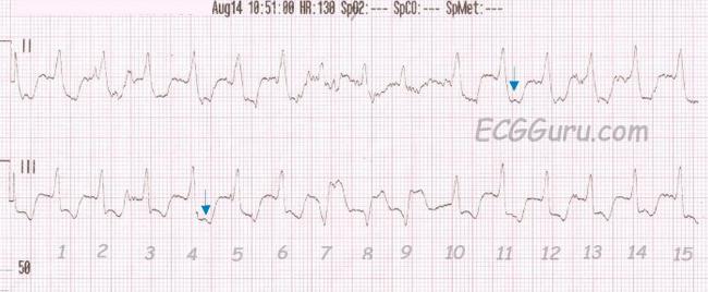 Capture Beats Ecg Guru Instructor Resources